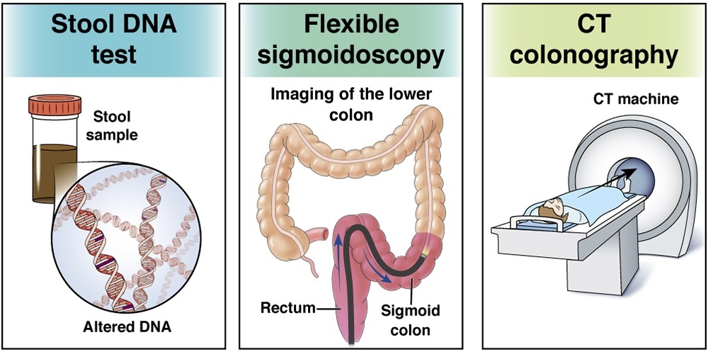 غربالگری سرطان روده بزرگ