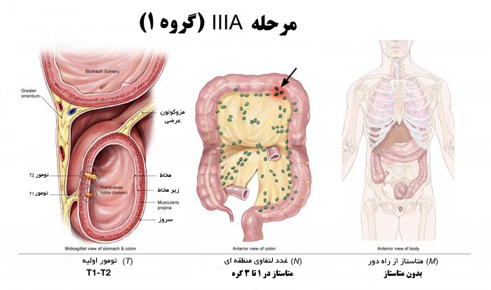 مرحله بندی سرطان روده بزرگ