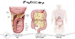 سرطان روده بزرگ گرید 3c