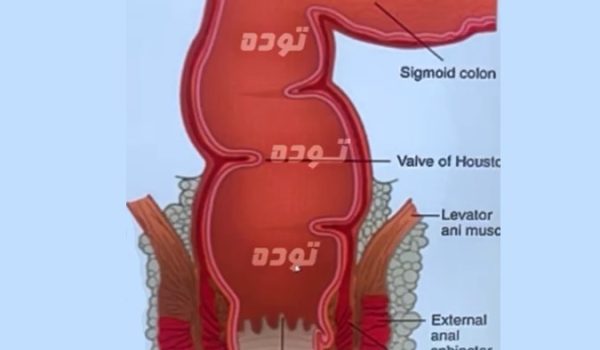 سرطان رکتوم یا راست روده