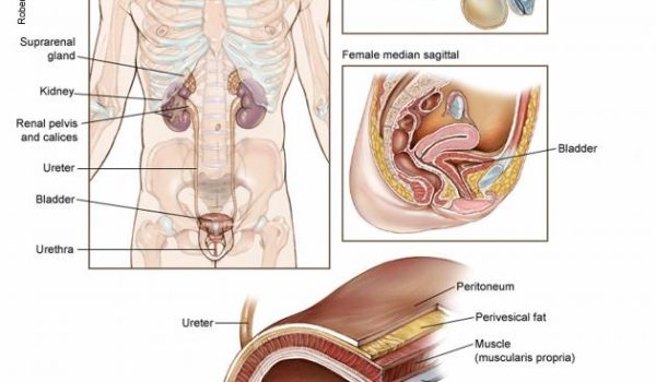 سرطان مثانه