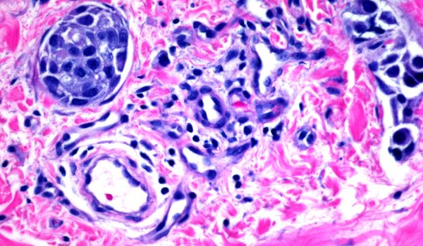 breastmalignantinflamcarLi04 عکس سرطان پستان التهابی