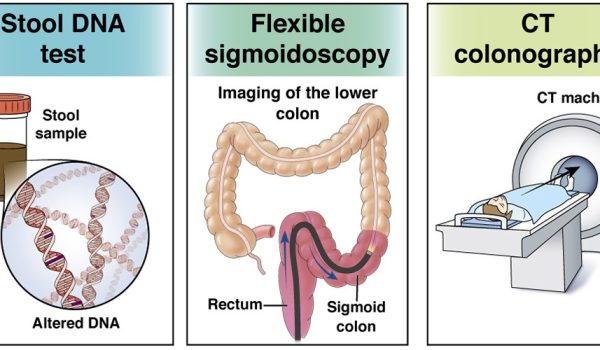 غربالگری سرطان روده بزرگ