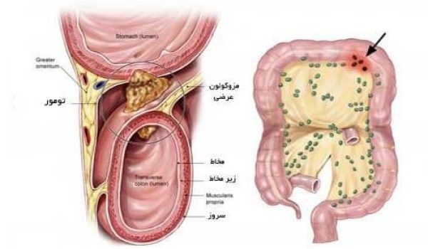 عوامل خطر سرطان کولون