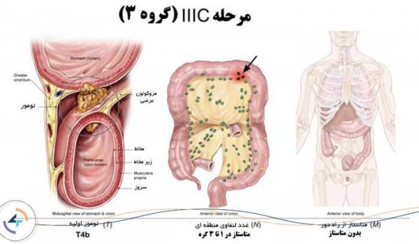 سرطان روده بزرگ گرید 3c