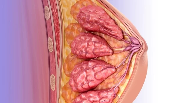 سرطان پستان زنان